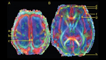 New research finds link between slower growth of pre-term infants and altered brain development