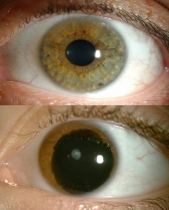 Top: a normal eye. Bottom: an aniridic eye.