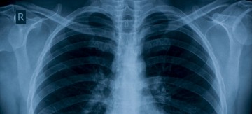 Biomarker test for “lung attacks” receives development funding