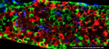 Stem cells show promise for reversing Type 2 diabetes