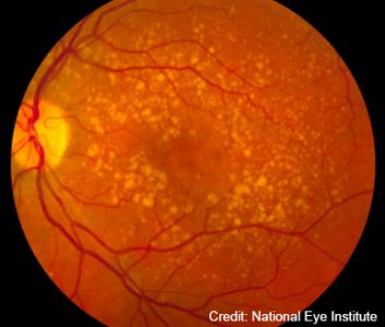 Macular degeneration treatment raises risk of glaucoma, Faculty of Medicine researchers find