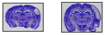 New approach to stroke treatment could minimize brain damage