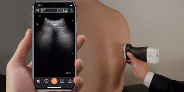 UBC researchers join with partners to develop portable ultrasound scanner network for COVID-19