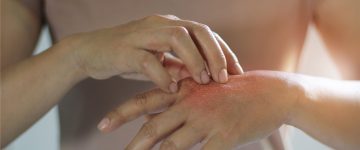 Researchers uncover novel approach for treating eczema