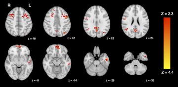 fMRI shows decreased functional connectivity in the brain following exposure to traffic pollution.